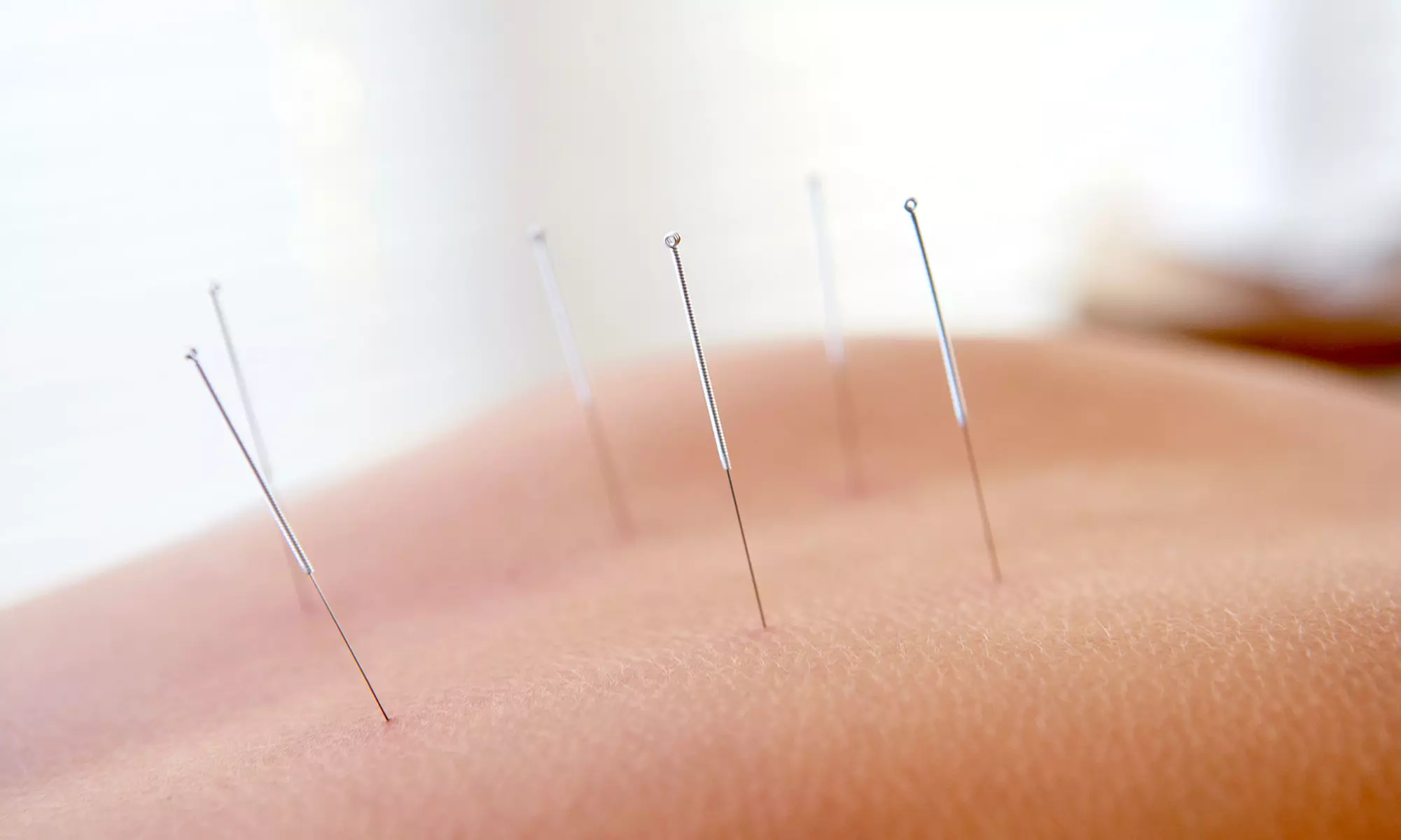 C$29 for 30-Minute Acupuncture Session with Consult and 30-Minute Massage at Millwoods Acupuncture Centre (C$123 Value) - Primary Image