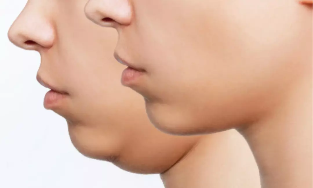 Customized Care Awaits: Fat Melting Meso Therapy: Small or Large Area