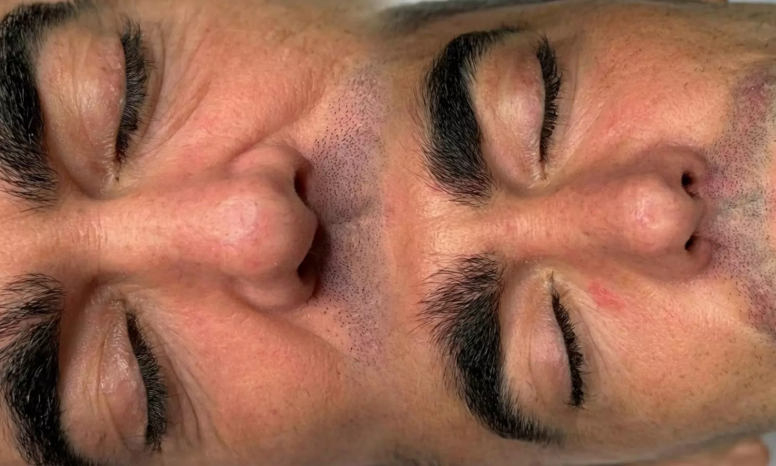 1 o 2 sesiones de plasma pen en zona a elegir para 1 persona