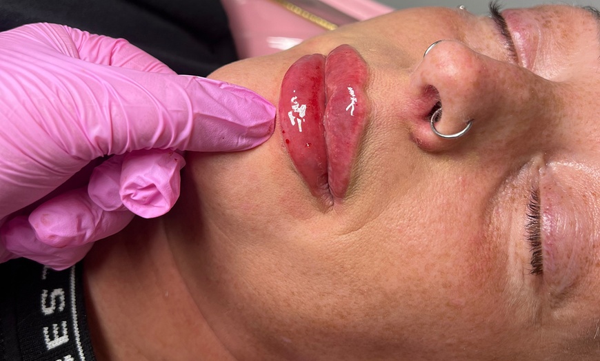 Image 3: 1 or 2 ML For Lip or Chin or Cheek with Consultation