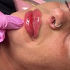 Image 3: 1 or 2 ML For Lip or Chin or Cheek with Consultation
