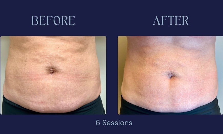 Image 7: Intro Cryo Slimming or 4 or 6 Cryo Contour Sessions