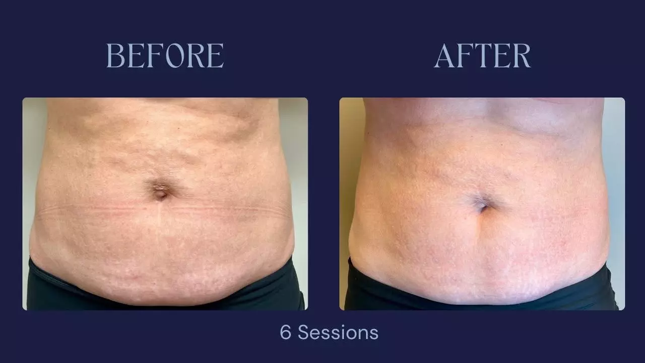 Intro Cryo Slimming or 4 or 6 Cryo Contour Sessions