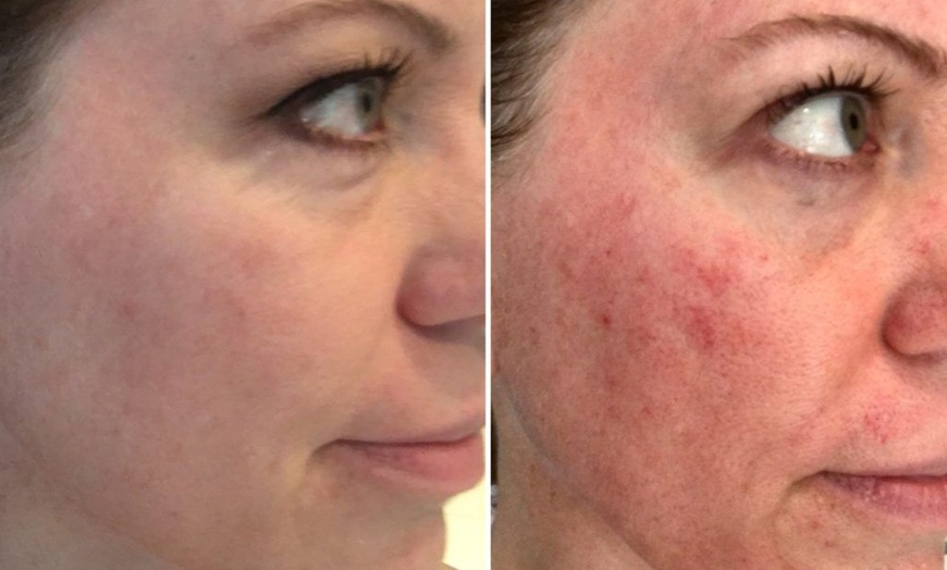 Image 3: Achieve Radiant Skin: Microdermabrasion Facial