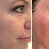 Image 3: Achieve Radiant Skin: Microdermabrasion Facial