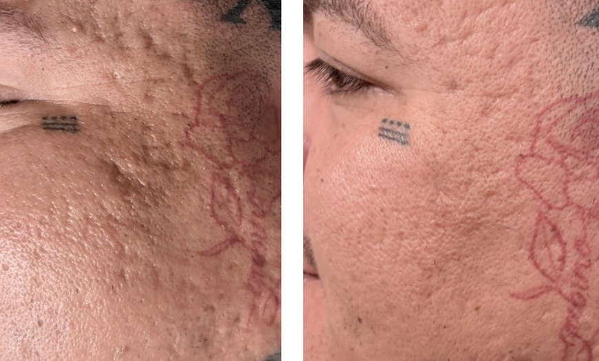 Image 6: One, Three, or Five Sessions of 60-Minutes Micro-Needling Treatment