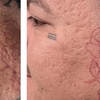 Image 6: One, Three, or Five Sessions of 60-Minutes Micro-Needling Treatment