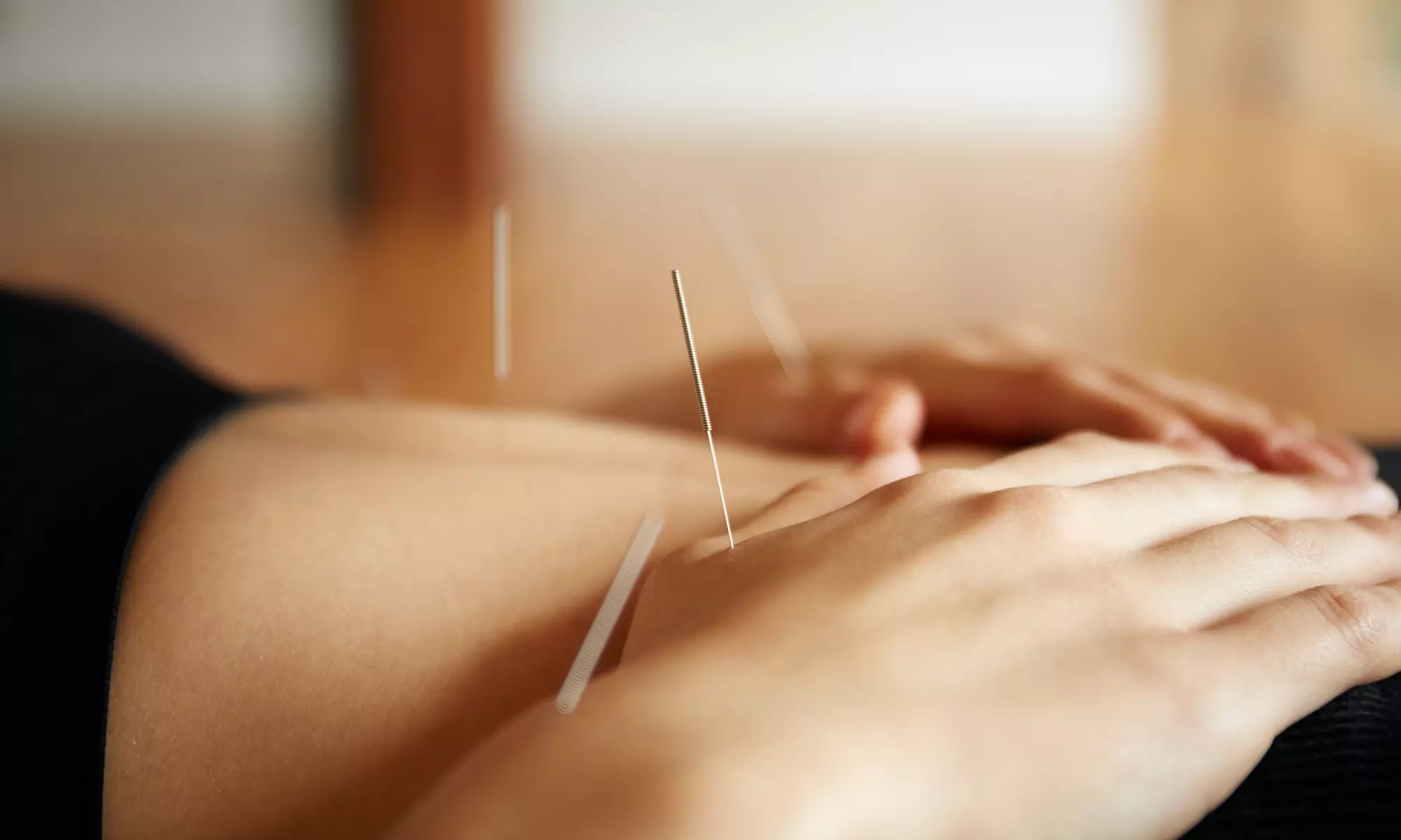 Discover wellness at Lowry Health & Wellness with acupuncture and consultation, up to 77% off, for a tailored experience - Primary Image
