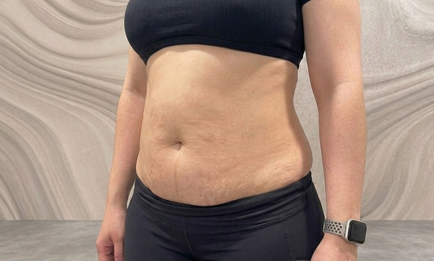 Image 3: Body Sculpting & Cellulite Reduction to Boost Contours & Confidence