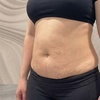 Image 3: Body Sculpting & Cellulite Reduction to Boost Contours & Confidence