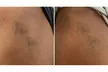Undo the Ink with Three Tattoo Removal Sessions on an Area Up to 2x2, 3x3 or 4x4 Inches ( Up to 51% Off ) - Second Medium