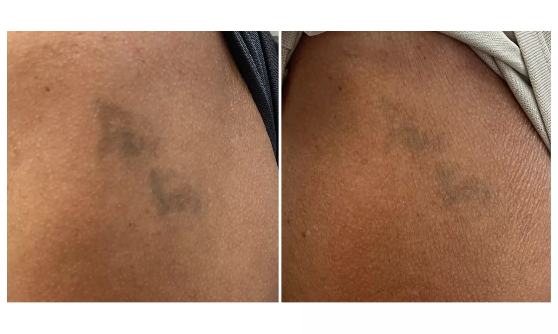 Three Tattoo Removal Sessions on an Area Up to 2x2, 3x3 or 4x4 Inches