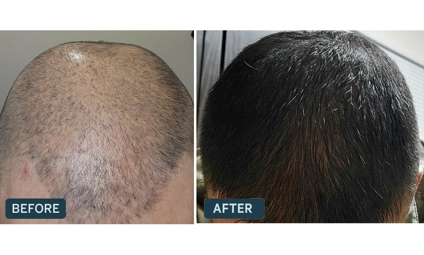 Image 5: Receive A Free Dermatologist Consultation with Big Savings on Rx Hair Growth Solutions At Happy Head