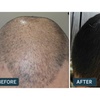 Image 6: Big Savings on Customized Rx Hair Growth Solutions and Receive A Free Dermatologist Consultation at Happy Head