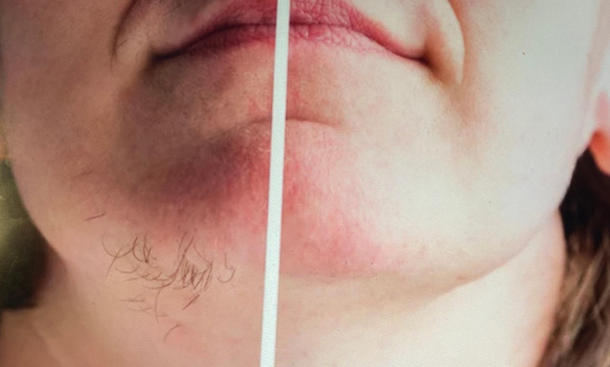 Image 3: Six Laser Hair Removal Treatments on a Small, Medium or Large Area
