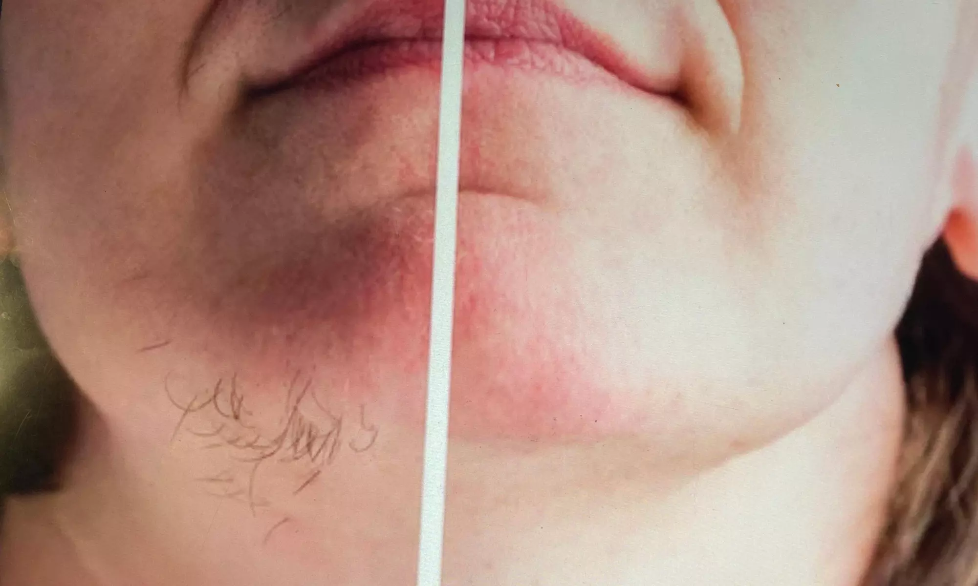 Six Laser Hair Removal Treatments on a Small, Medium or Large Area