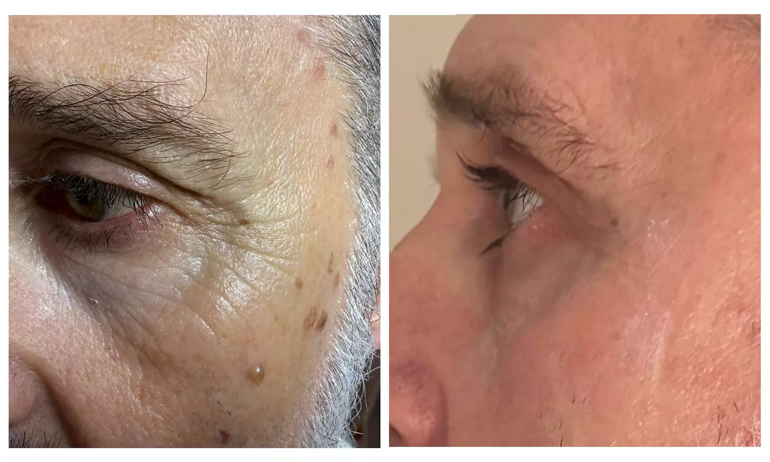 Plasma pen facial no quirúrgico para manchas y zona periocular