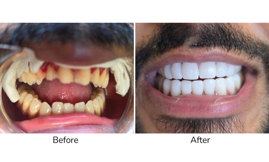 Image 2: 1 Veneer at Your Covina Family Dentistry 