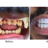 Image 2: 1 Veneer at Your Covina Family Dentistry 