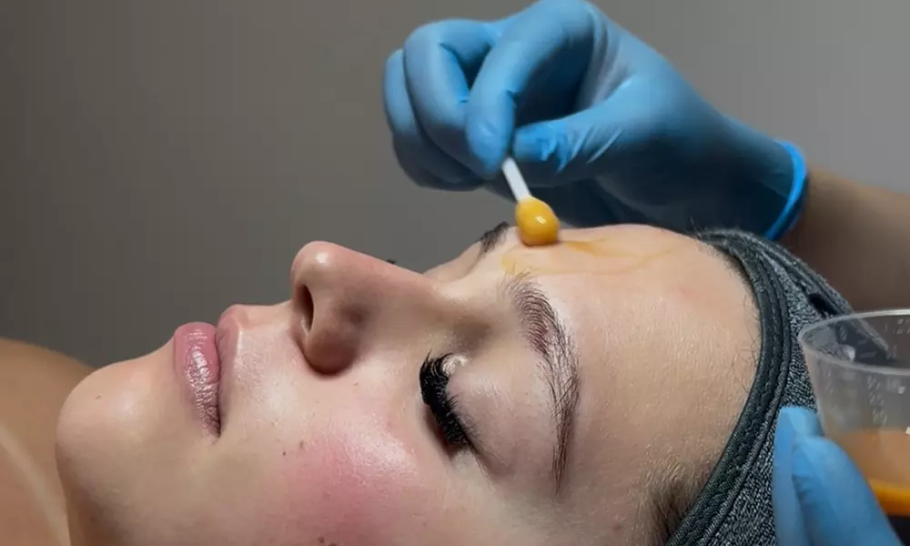 One VISIA Skin Assessment and One Clinical Chemical Peel