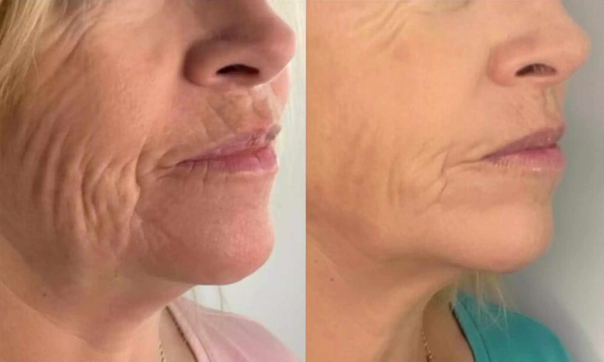 Radio Frequency Skin Tightening Treatment