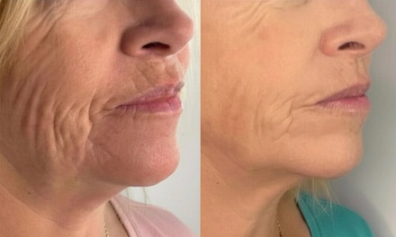 30% off Immediate Skin Tightening with Radio Frequency Technology at DOLA Skincare and Esthetics - DOLA Skincare and Esthetics