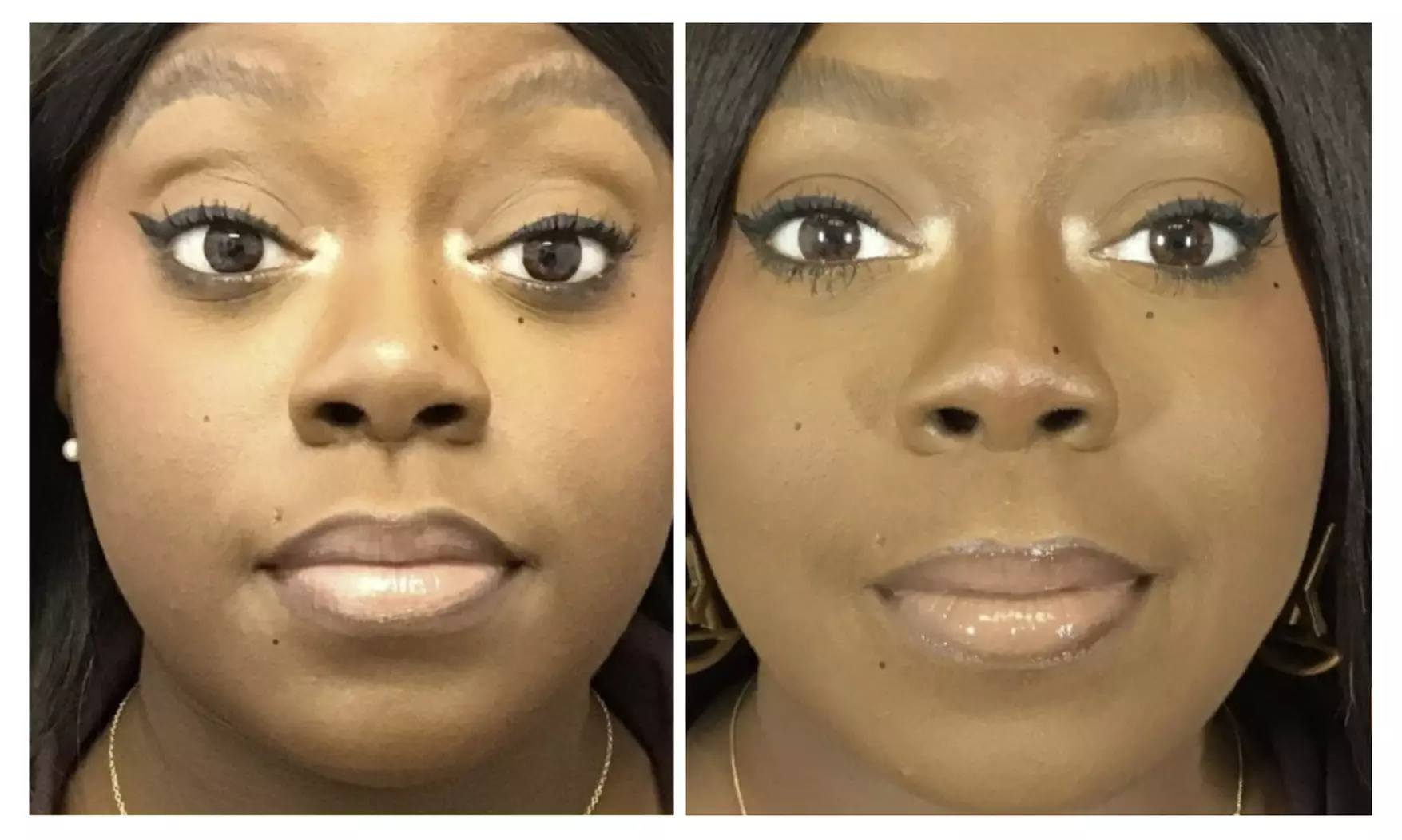 Get Smooth Skin with  20 or 40 Units of Botox 