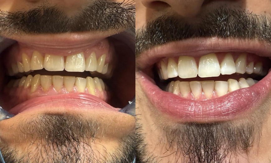 Image 2: Kosmetisches Zahn-Bleaching bis zu 3, 6 oder 9 Stufen für 1 Person