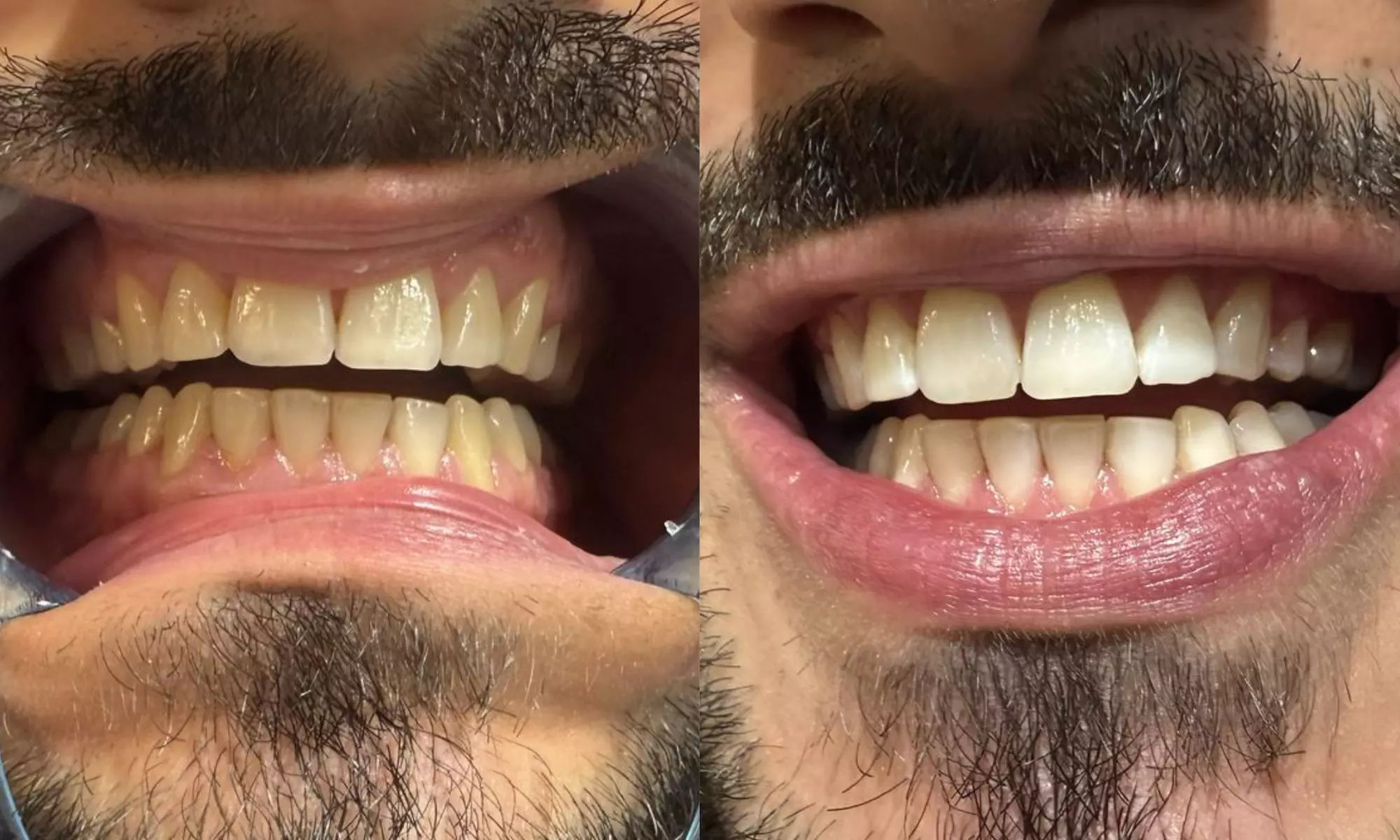 Kosmetisches Zahn-Bleaching bis zu 3, 6 oder 9 Stufen für 1 Person