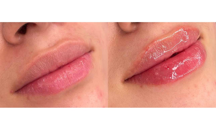 Image 6: Sesiones de rehidratación de labios o microlifting facial con Dermapen