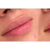 Image 6: Sesiones de rehidratación de labios o microlifting facial con Dermapen