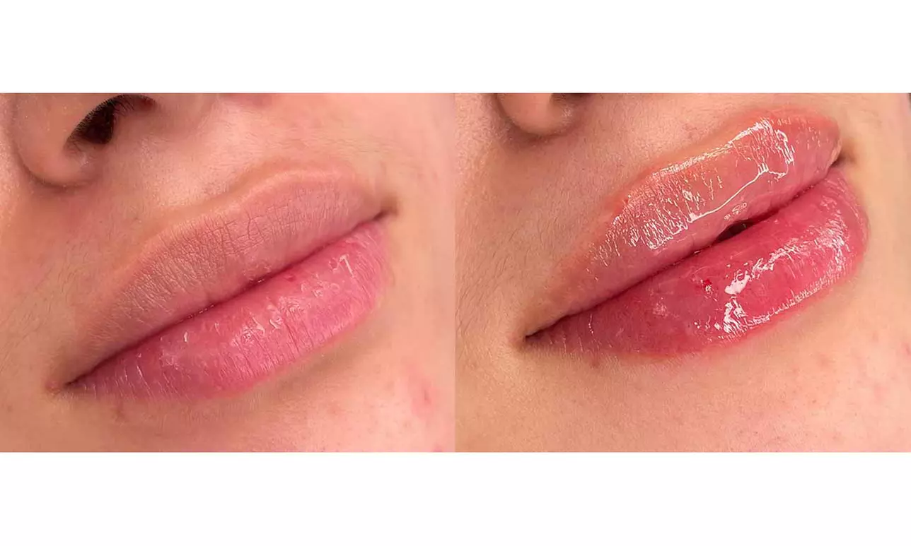 Sesiones de rehidratación de labios o microlifting facial con Dermapen