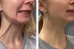 Reveal a Relaxed Look with 20, 40, or 60 Botox Units (Up to 44% Off) - Second Medium