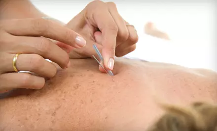 One or Three Acupuncture Treatments at Leonard Chiropractic in Fairview Park (Up to 71% Off) - Primary Image