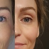 Image 1: Plasmalift: Oberlidstraffung & Lifting mit Skin Corrector für 1 Person