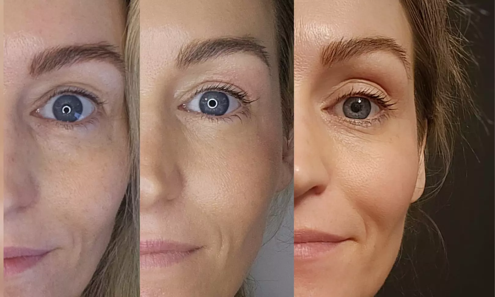 Plasmalift: Oberlidstraffung & Lifting mit Skin Corrector für 1 Person