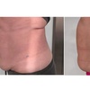 Image 9: Vivien laser do lipolizy tkanki tłuszczowej wybranych partii ciała
