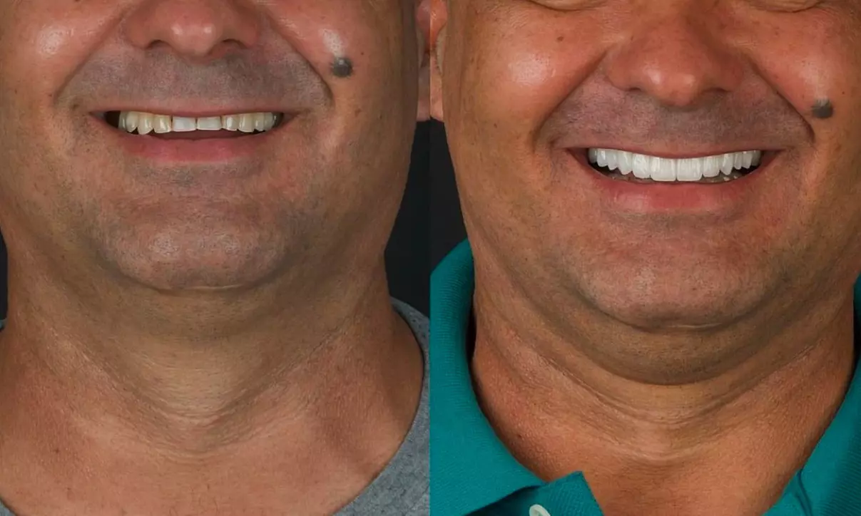 Colocación de hasta 4 carillas dentales de composite o cerámica