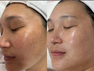 60-Minute PCA Deep Pore Detox Treatment with Extraction  - W&M Beauty Center