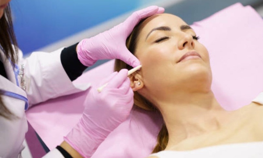 Image 9: Lifting facial: 8 o 12 hilos tensores monofilamento o 6 multifilamento