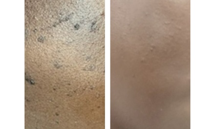 2 - one hour sessions for non-invasive DPN and Skin Tag removal service - Spa Life Sanctuary