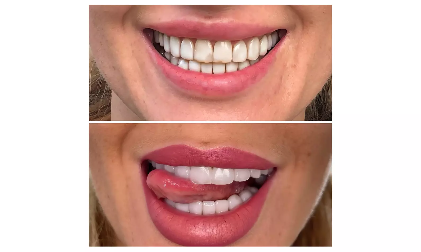 Achieve a Radiant Smile with In-Office Whitening/Cleaning Options