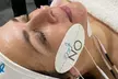 1 o 2 sesiones de lifting facial sin cirugía On-Face con opción a higiene facial, ahorra hasta un 61% - Second Medium