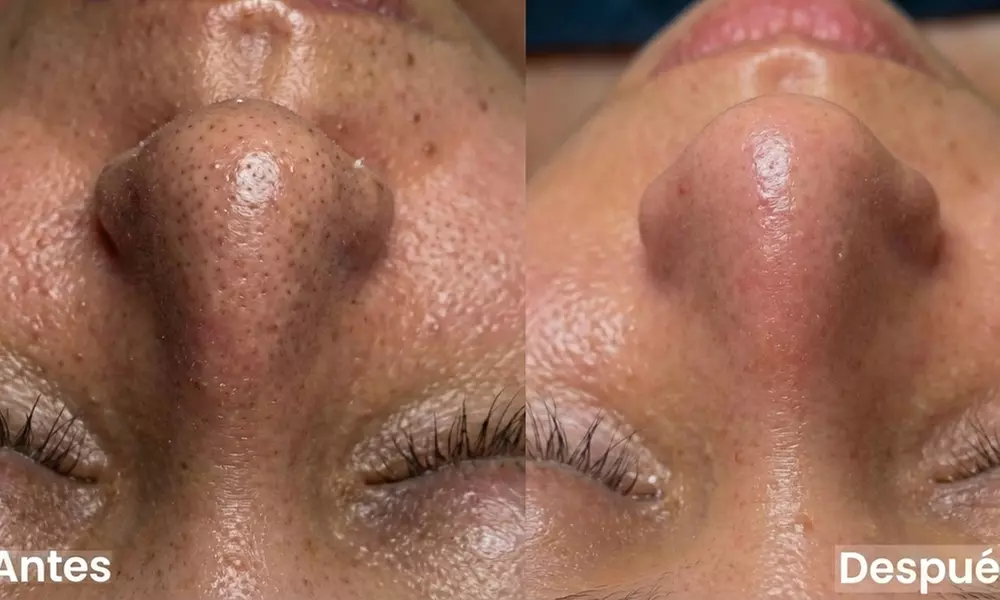 Tratamiento de hidrolimpieza facial con opción a masaje para 1 persona