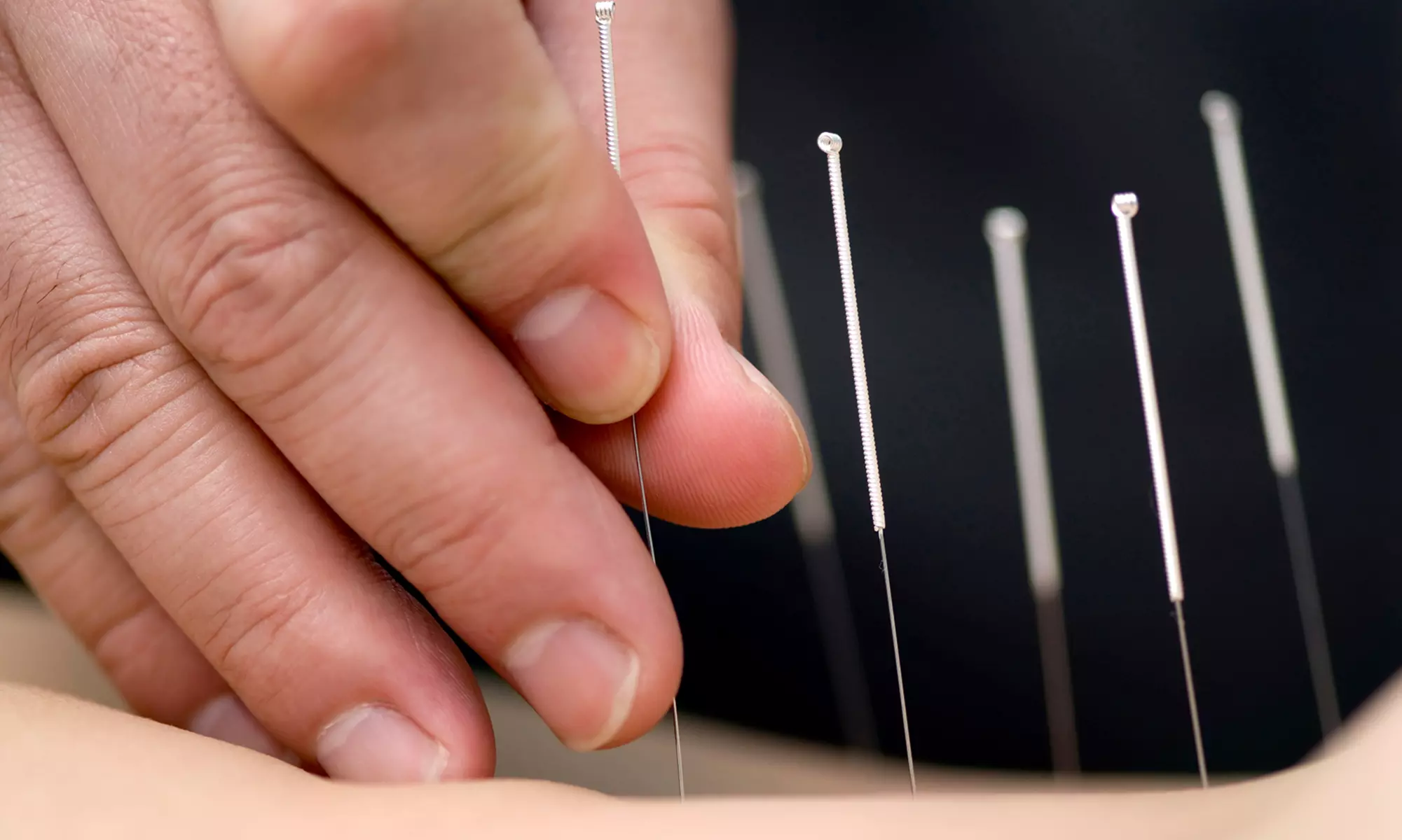 One Acupuncture Treatment at Acupuncture & Chinese Medical Center (65% Off)  - Primary Image
