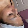 Image 3: Get 50, 100, or 150 Units of Dysport Treatments