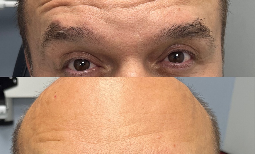 Image 5: Refresh Your Skin with 20, 40, or 60 Units of Neurotoxin