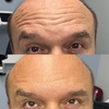 Image 5: Refresh Your Skin with 20, 40, or 60 Units of Neurotoxin