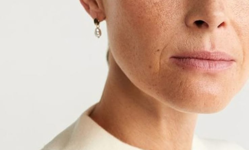 Image 9: Plump, Smooth & Glow: 0.5, 1 or 2 ml Dermal Filler with Consultation