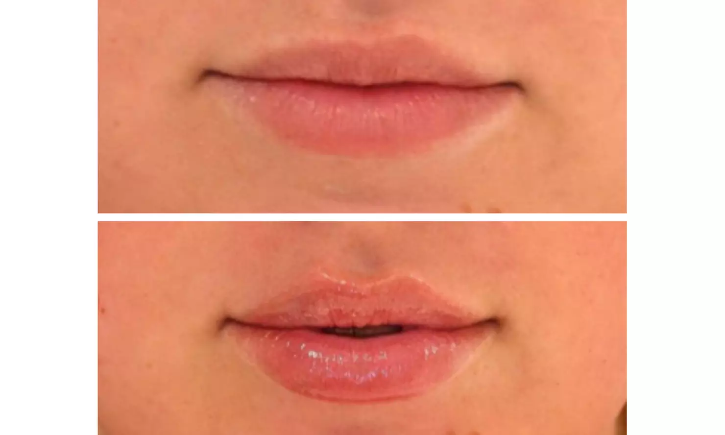 Half or Full Syringe of Versa Filler for Natural Enhancement